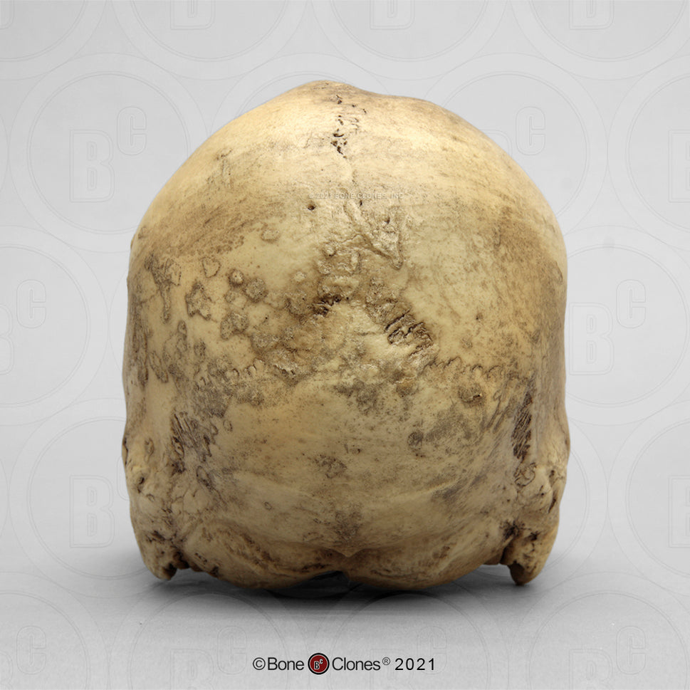 Bone Clones Forensic Trauma Skulls