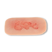 Wound Moulage