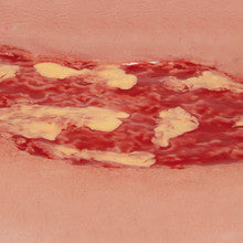 Wound Moulage