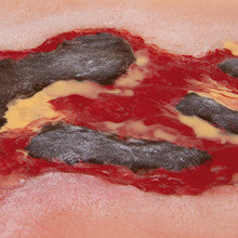 Wound Moulage