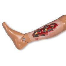 Wound Moulage