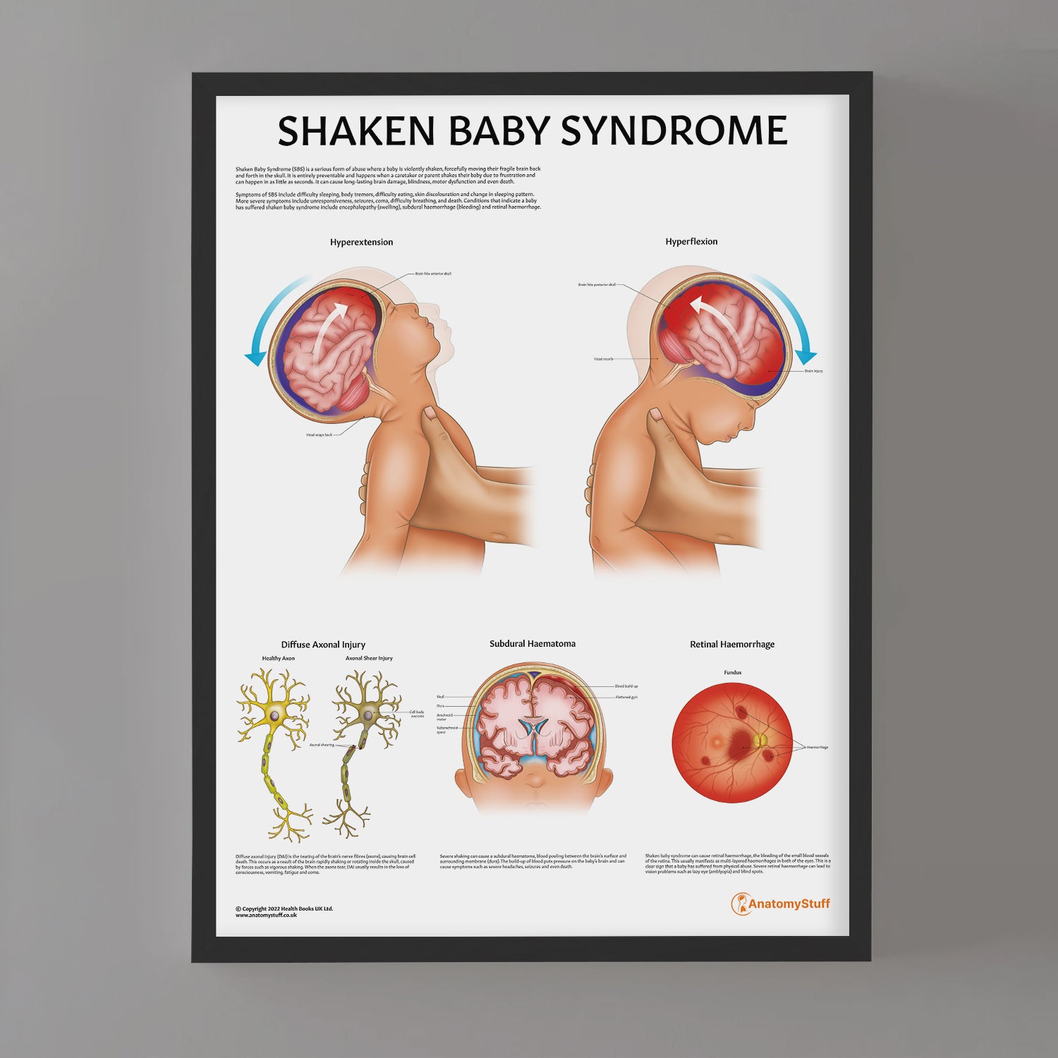 Shaken Baby Syndrome Chart / Poster