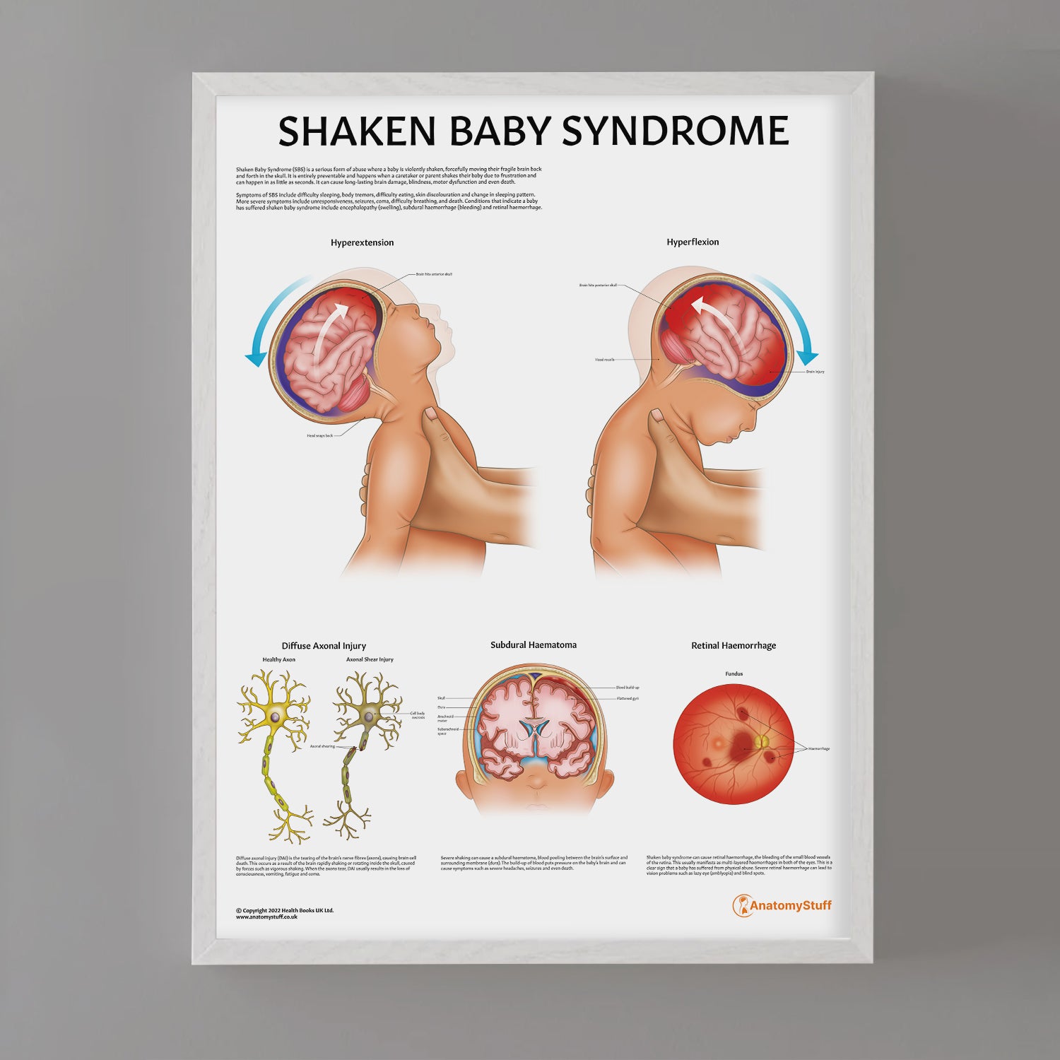 Shaken Baby Syndrome Chart / Poster