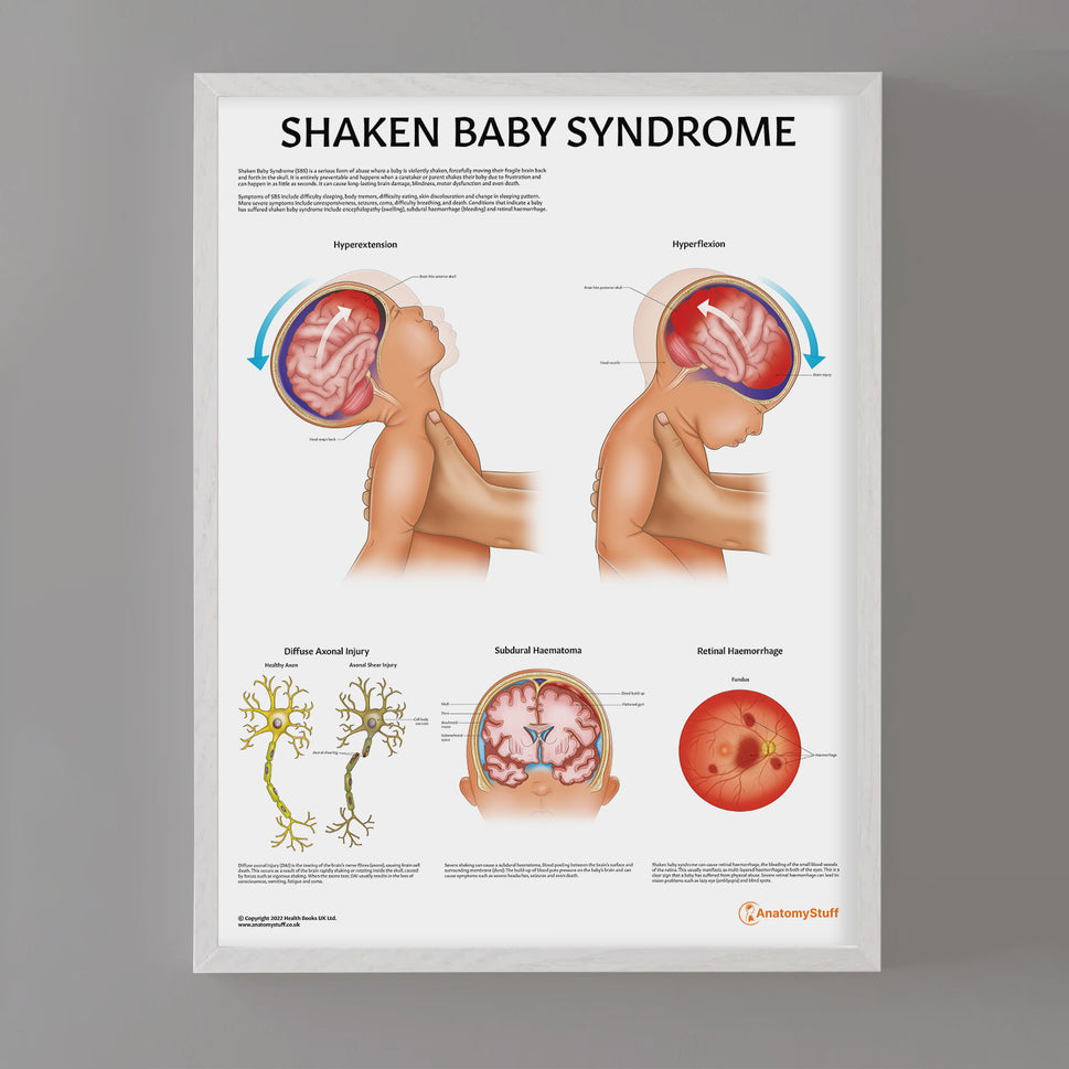 Shaken Baby Syndrome Chart / Poster