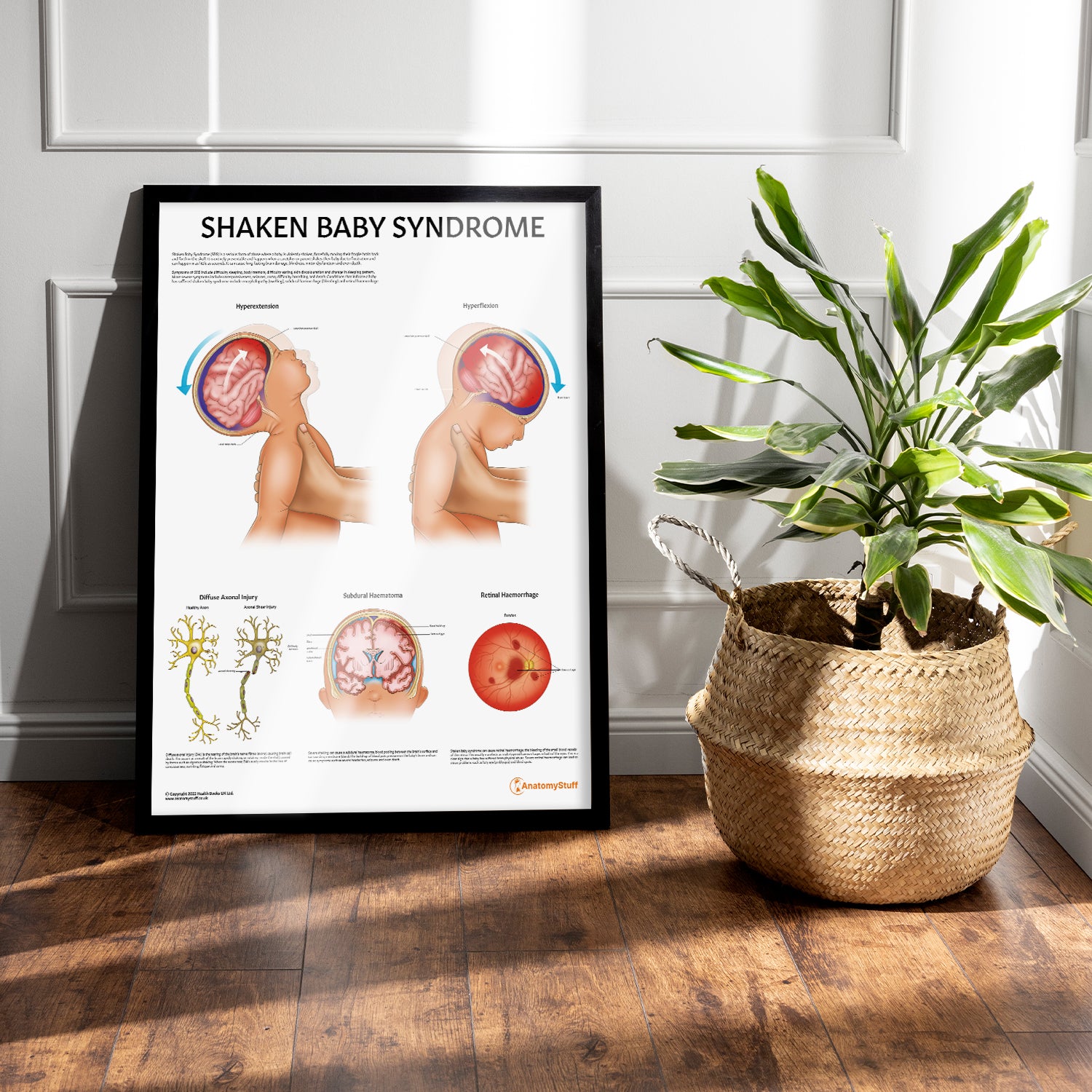 Shaken Baby Syndrome Chart / Poster