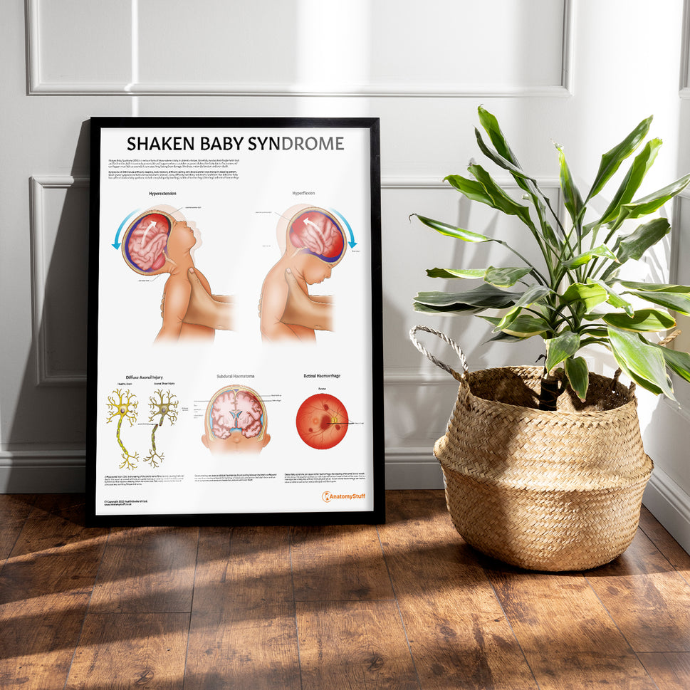 Shaken Baby Syndrome Chart / Poster