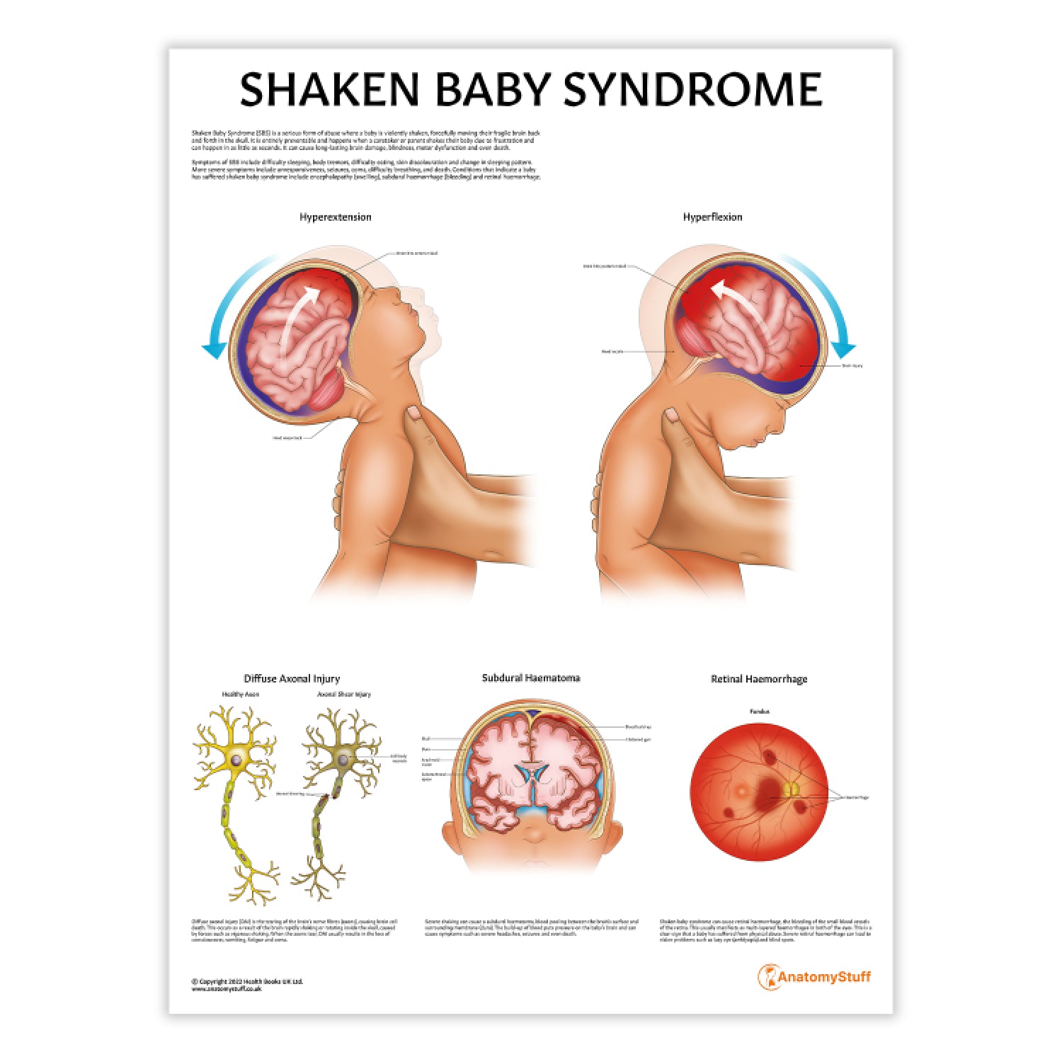 Shaken Baby Syndrome Chart / Poster