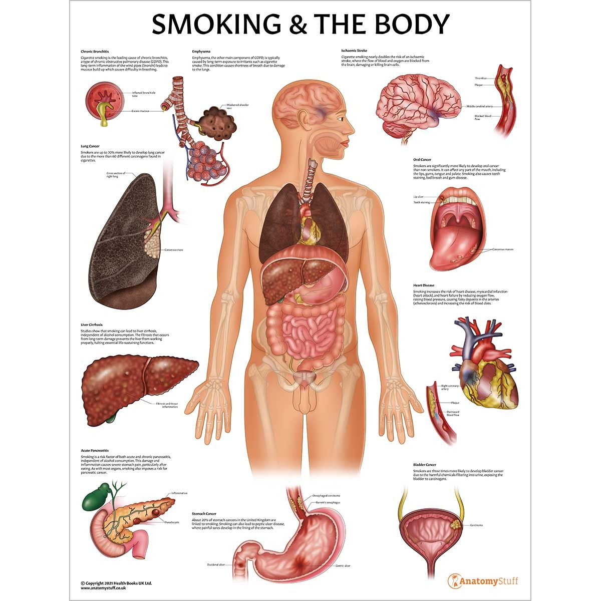 Smoking and The Body Laminated Chart / Poster (SMKBDY)