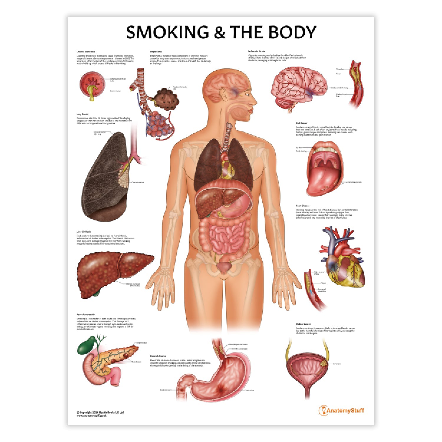 Smoking and The Body Chart / Poster - Part of Collection