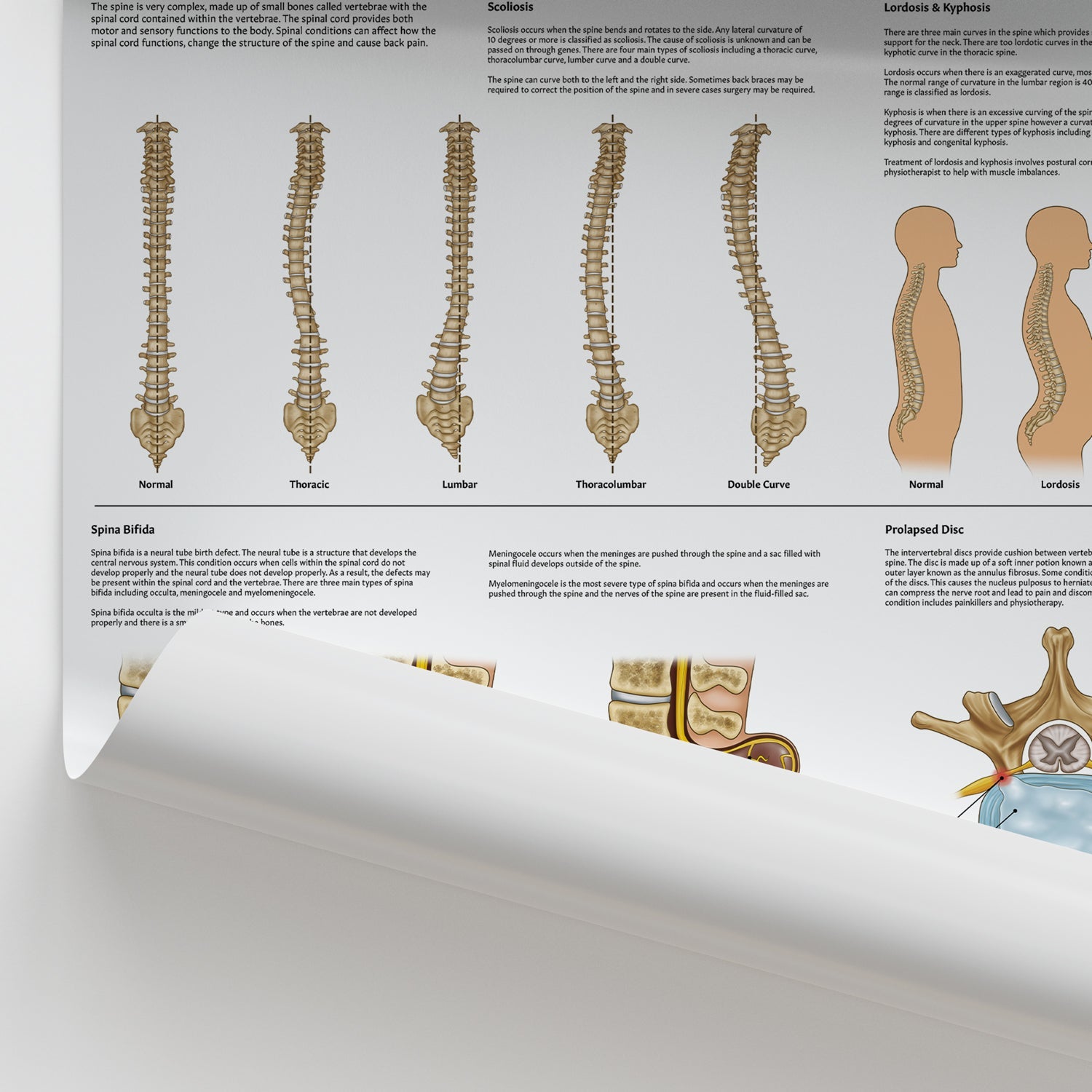 Spinal Conditions Chart / Poster - Part of Collection