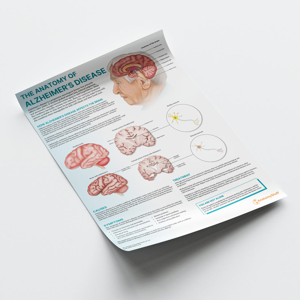 The Anatomy of Alzheimer's Disease Chart / Poster