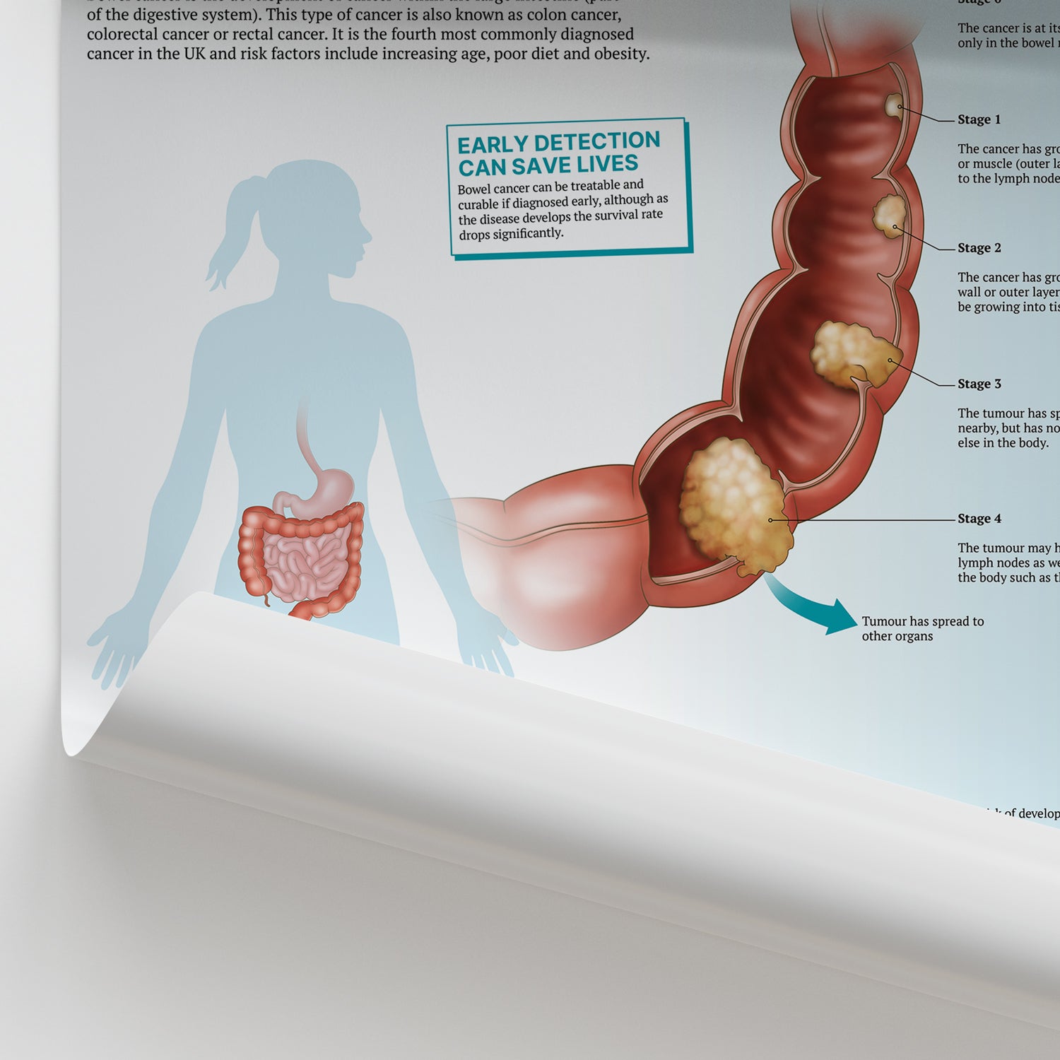The Anatomy of Bowel Cancer Chart / Poster