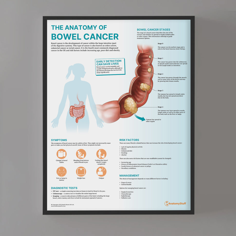 The Anatomy of Bowel Cancer Chart / Poster
