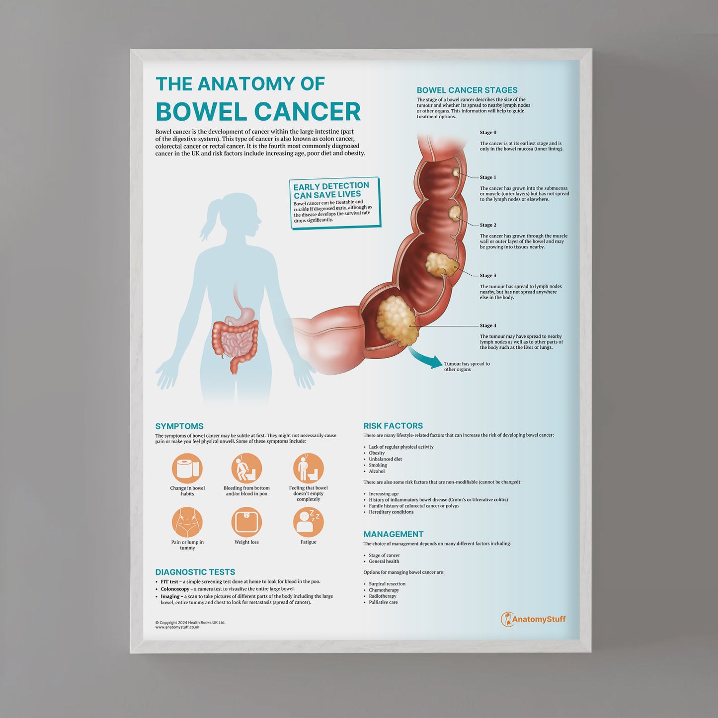 The Anatomy of Bowel Cancer Chart / Poster