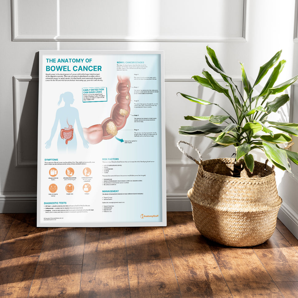 The Anatomy of Bowel Cancer Chart / Poster