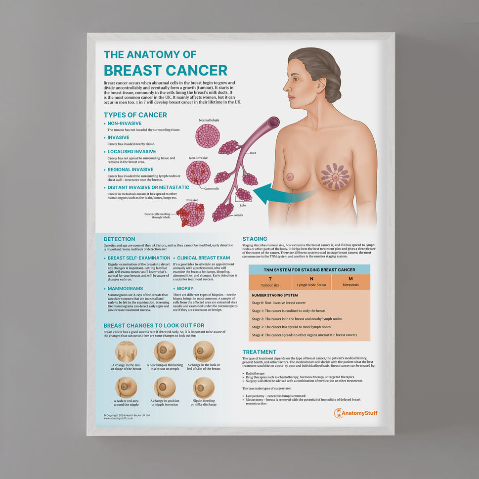 The Anatomy of Breast Cancer Chart / Poster