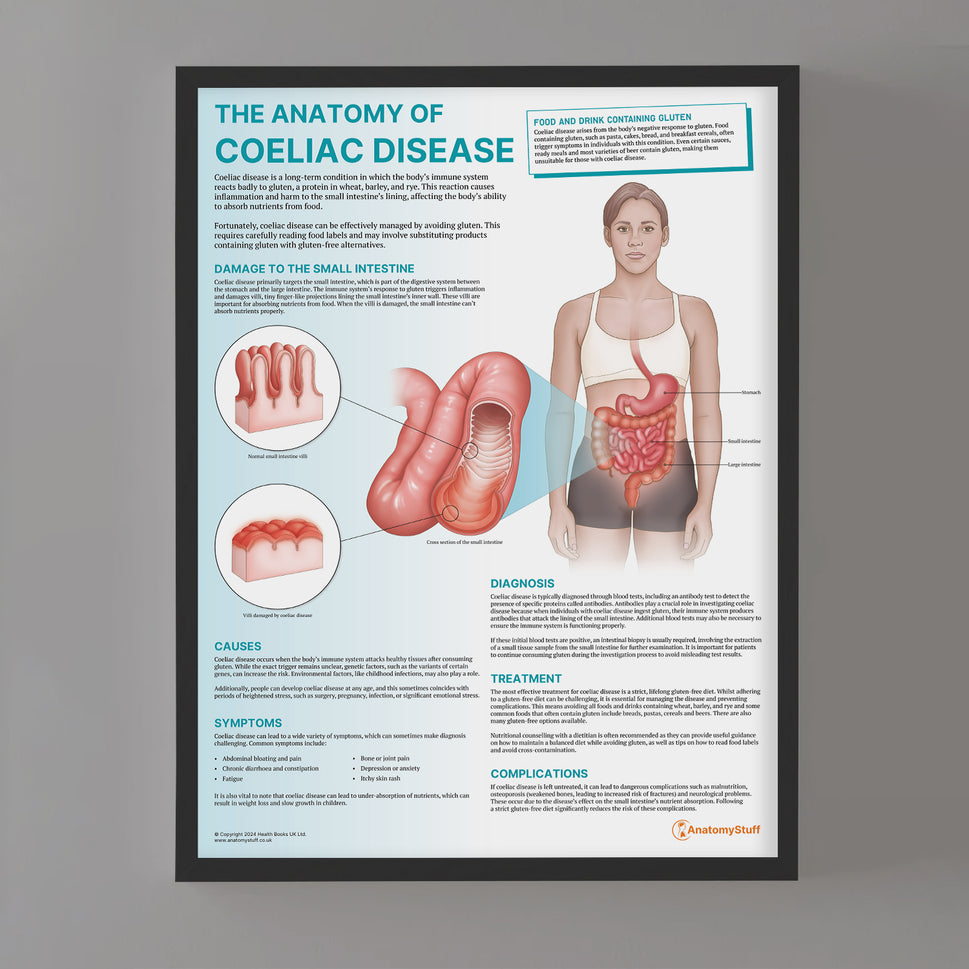 The Anatomy of Coeliac Disease Chart / Poster