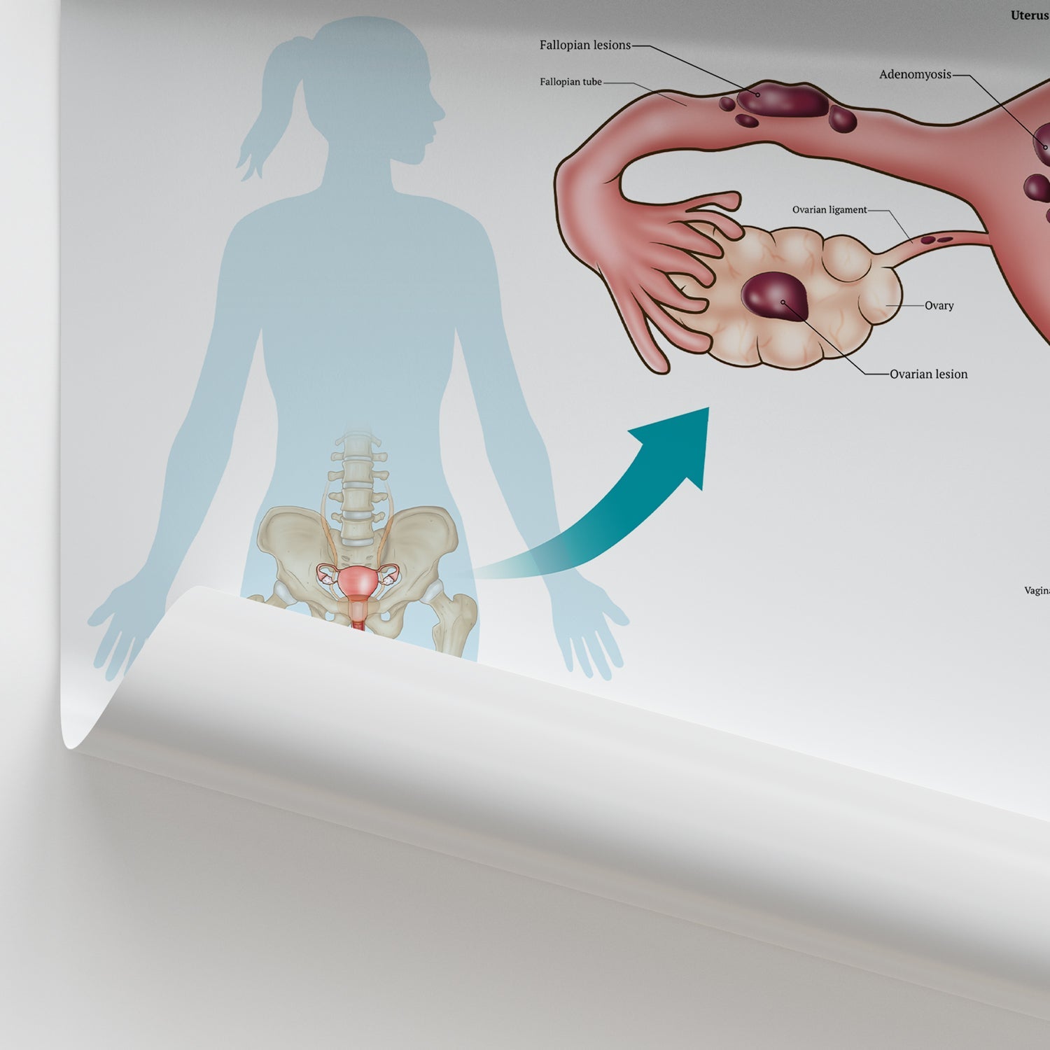 The Anatomy of Endometriosis Chart / Poster - Part of Collection