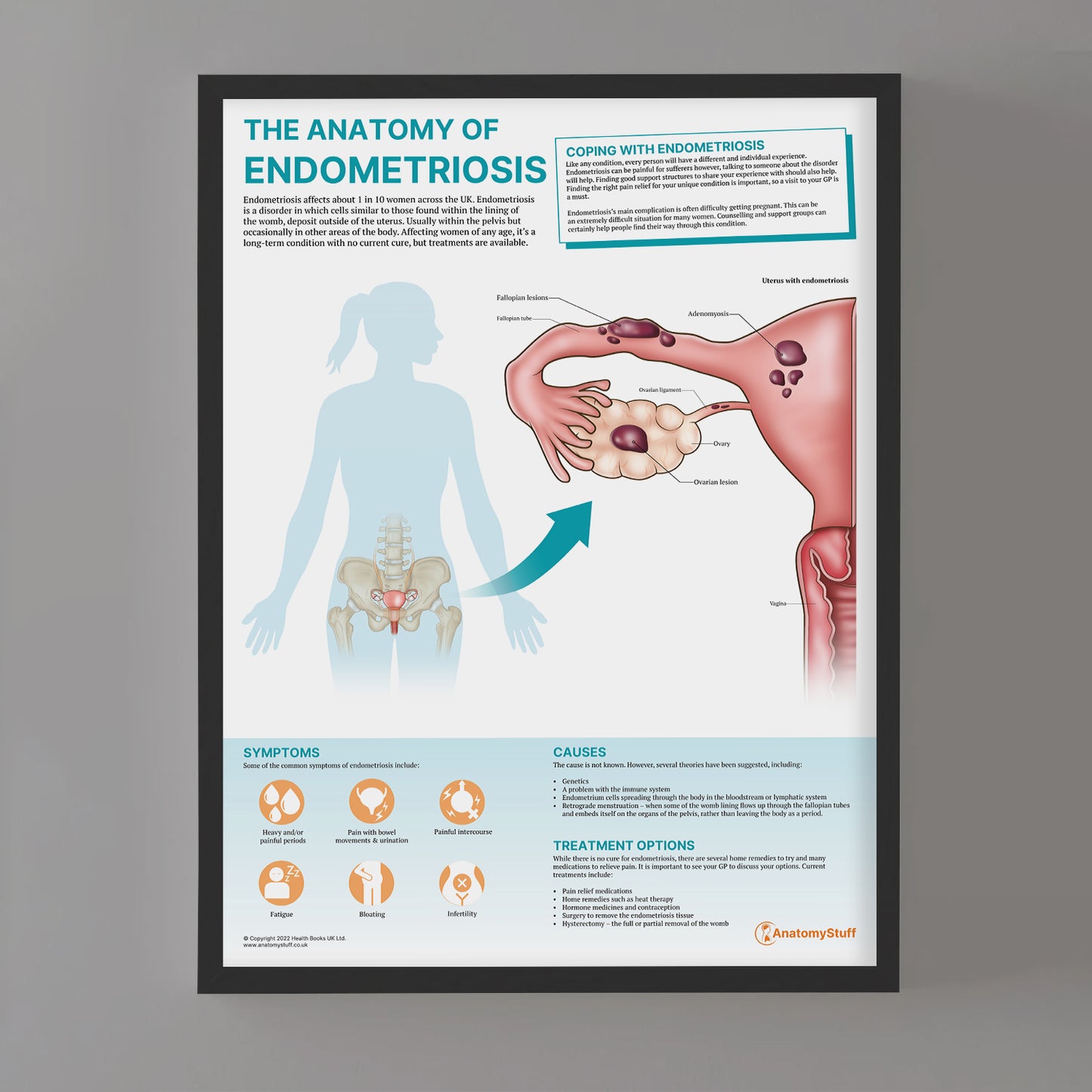 The Anatomy of Endometriosis Chart / Poster
