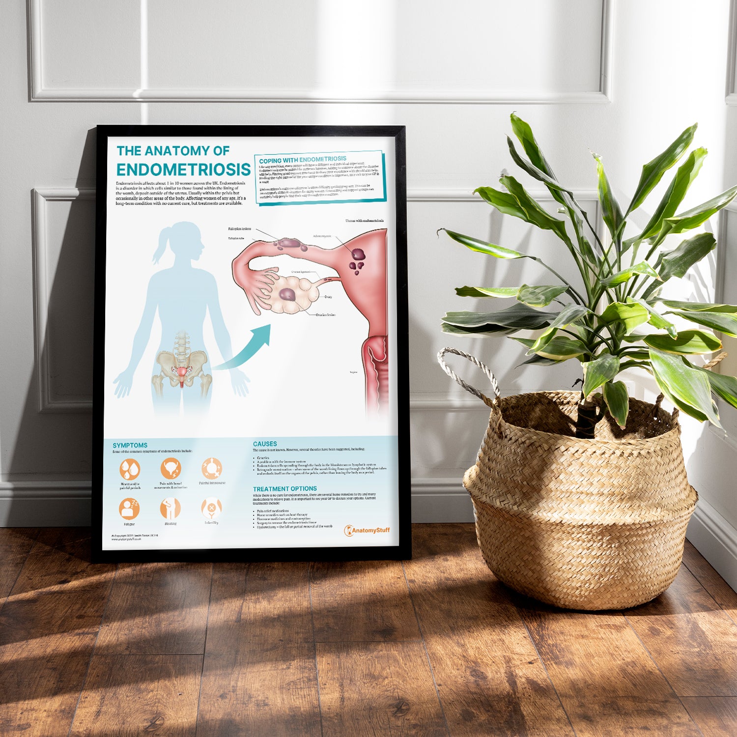 The Anatomy of Endometriosis Chart / Poster
