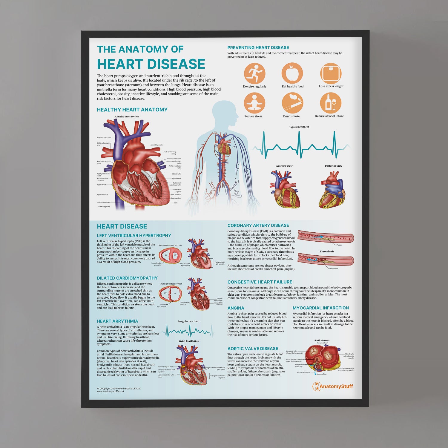 The Anatomy of Heart Disease Chart / Poster