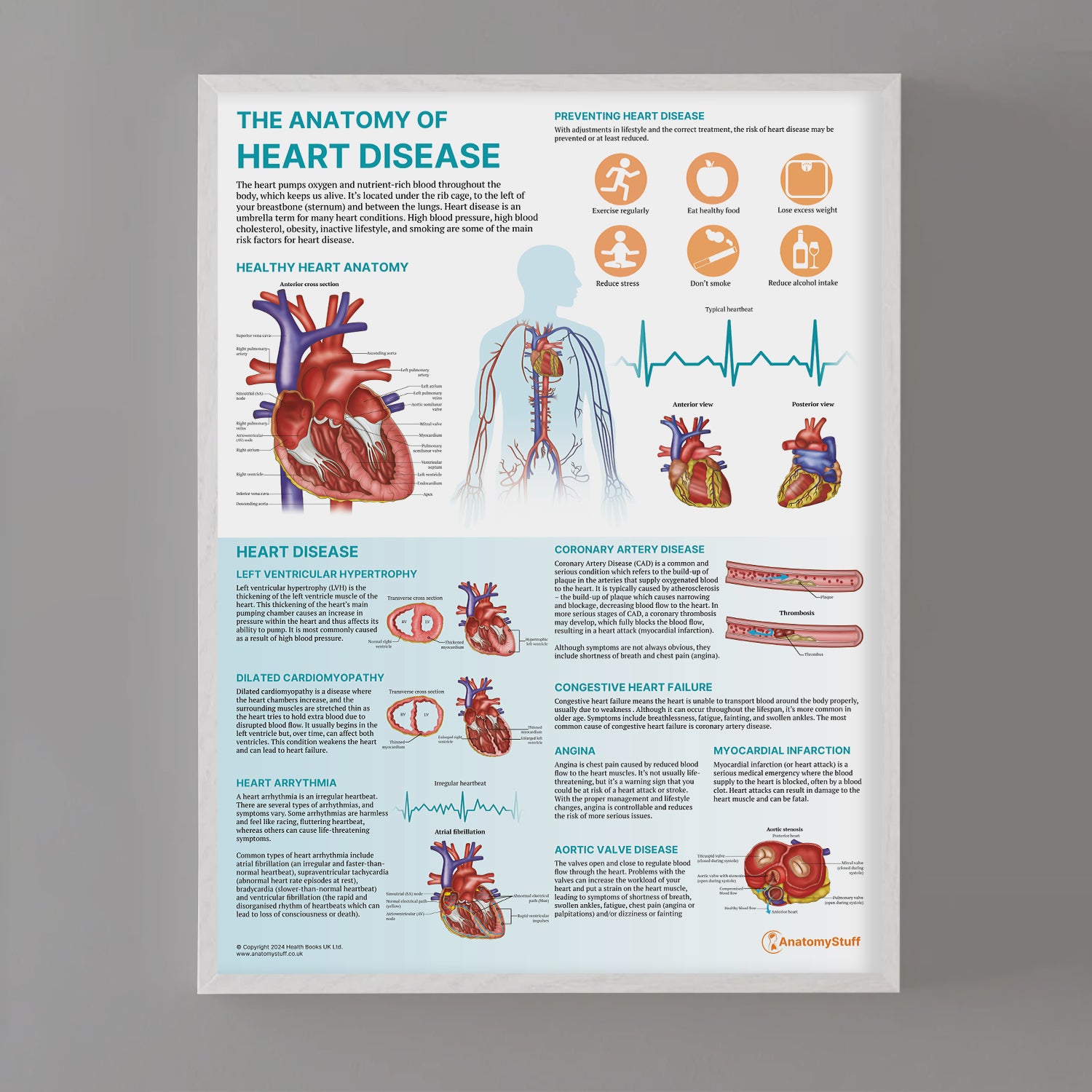The Anatomy of Heart Disease Chart / Poster