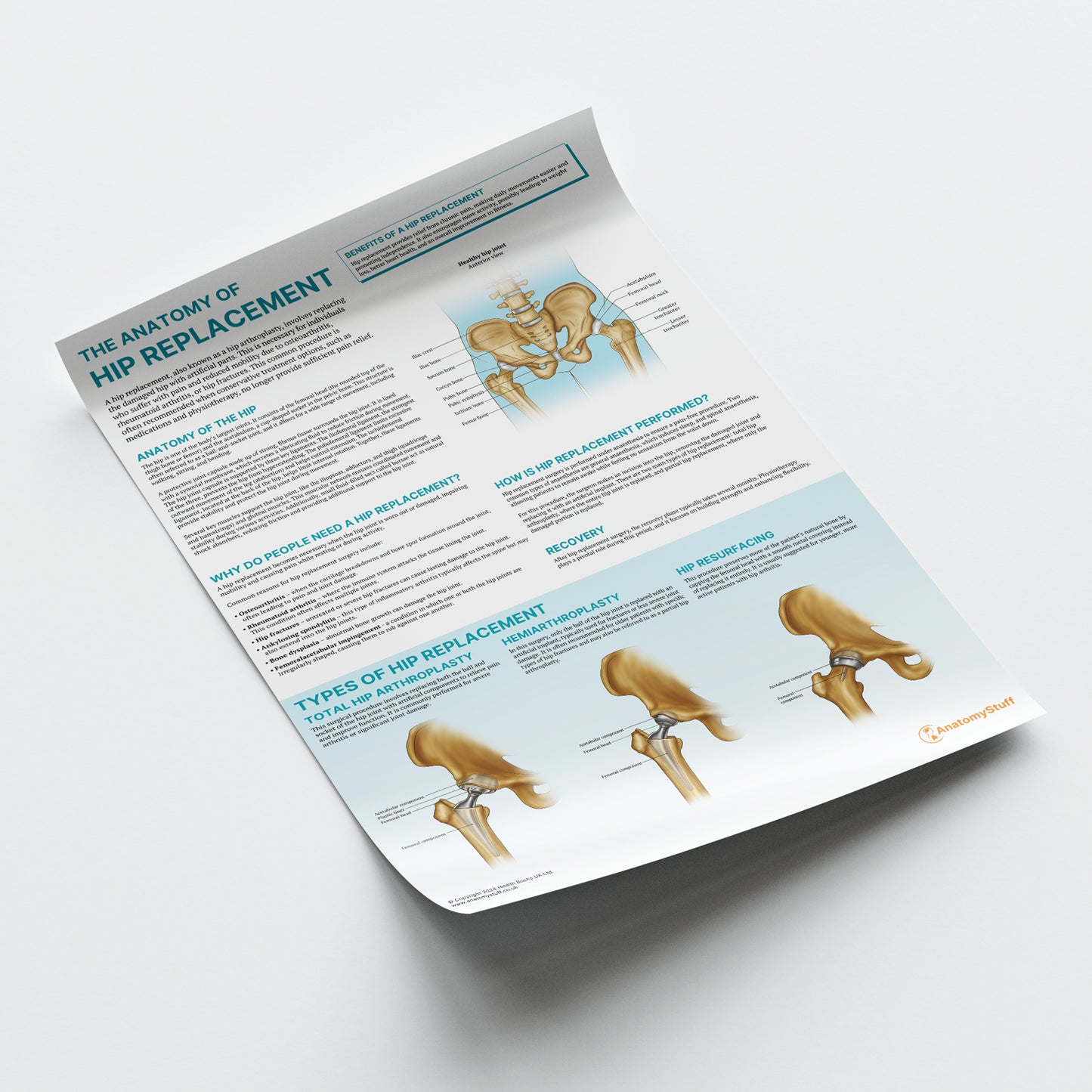 The Anatomy of Hip Replacement Chart / Poster