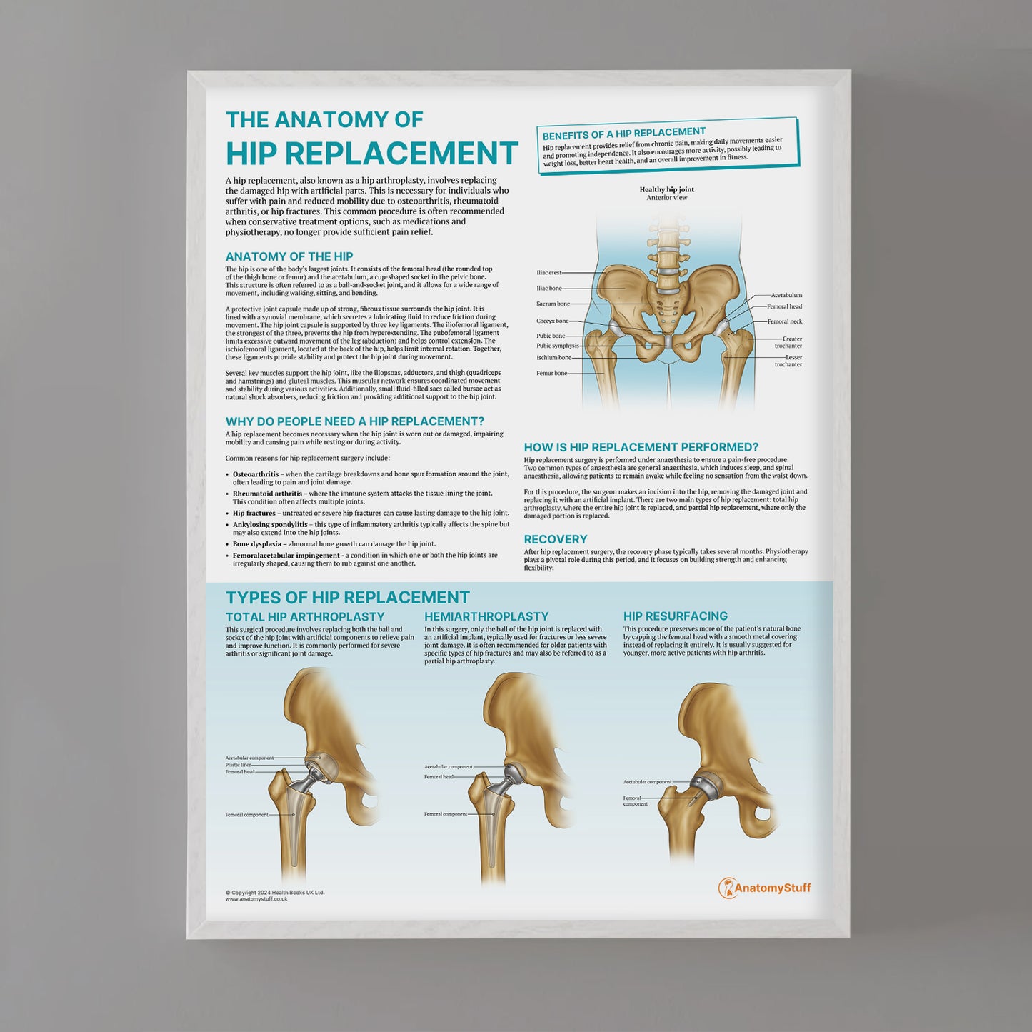 The Anatomy of Hip Replacement Chart / Poster