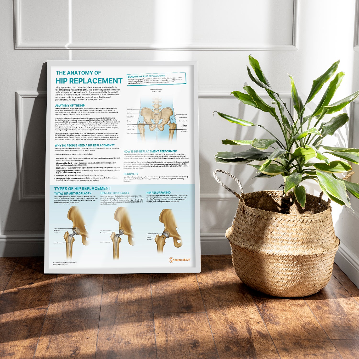 The Anatomy of Hip Replacement Chart / Poster