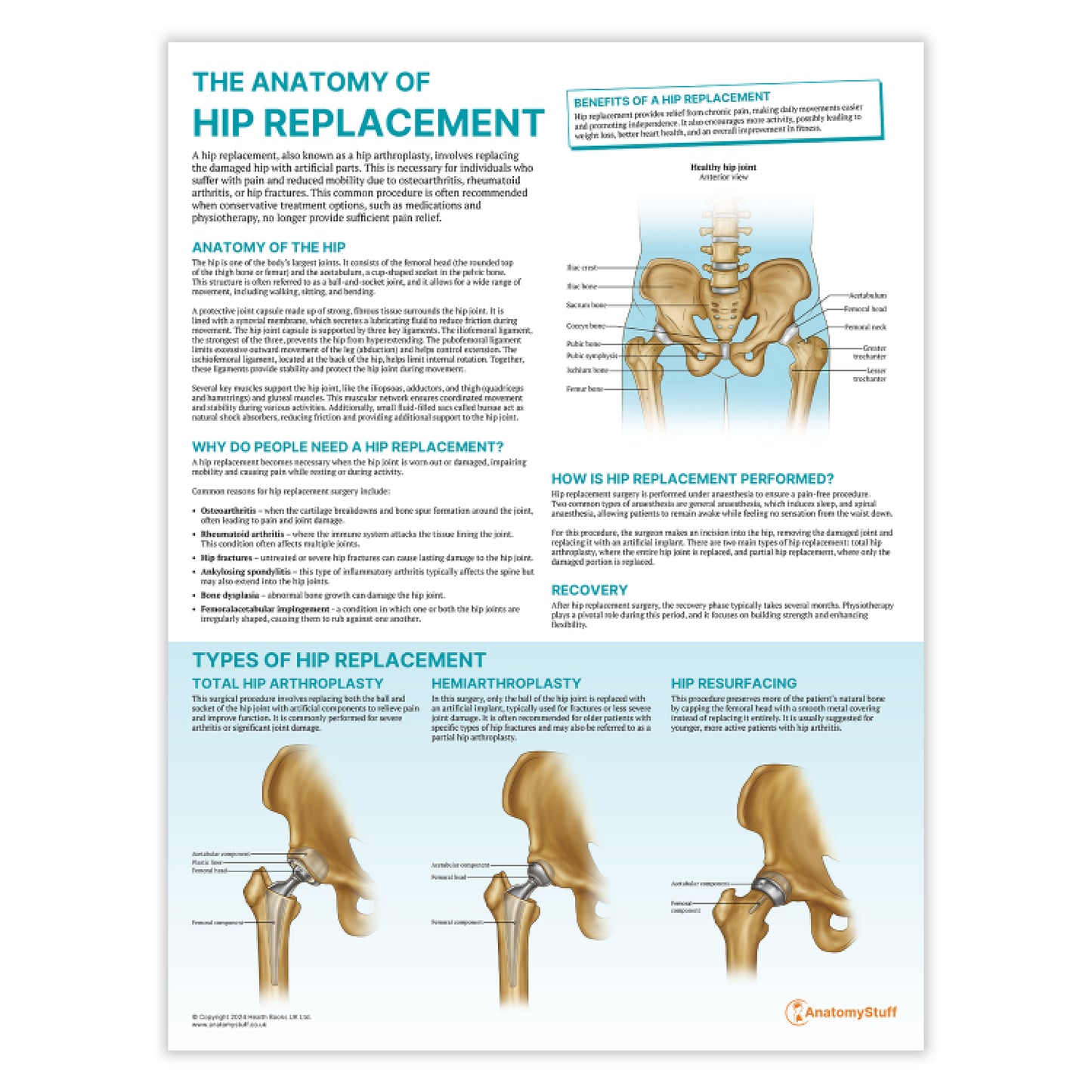 The Anatomy of Hip Replacement Chart / Poster