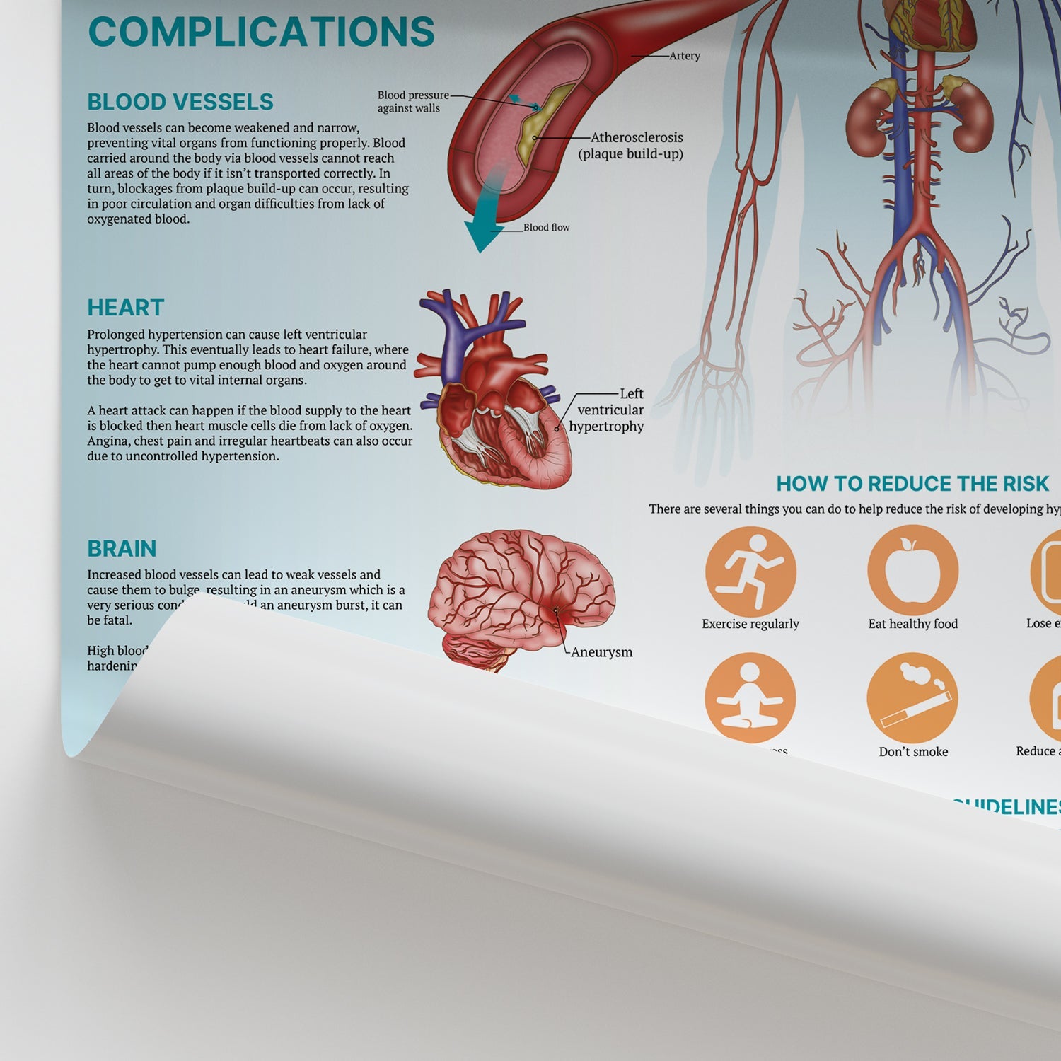 The Anatomy of Hypertension Chart / Poster - Part of Collection