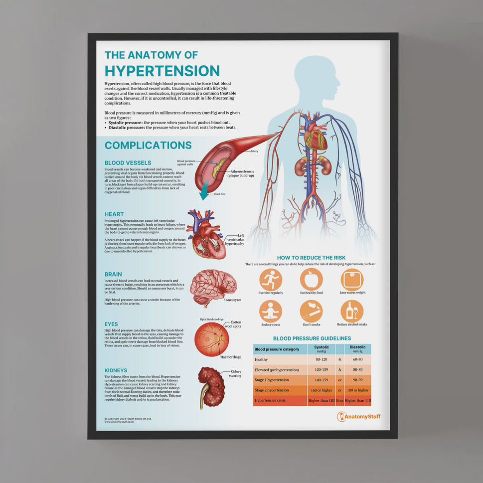 The Anatomy of Hypertension Chart / Poster