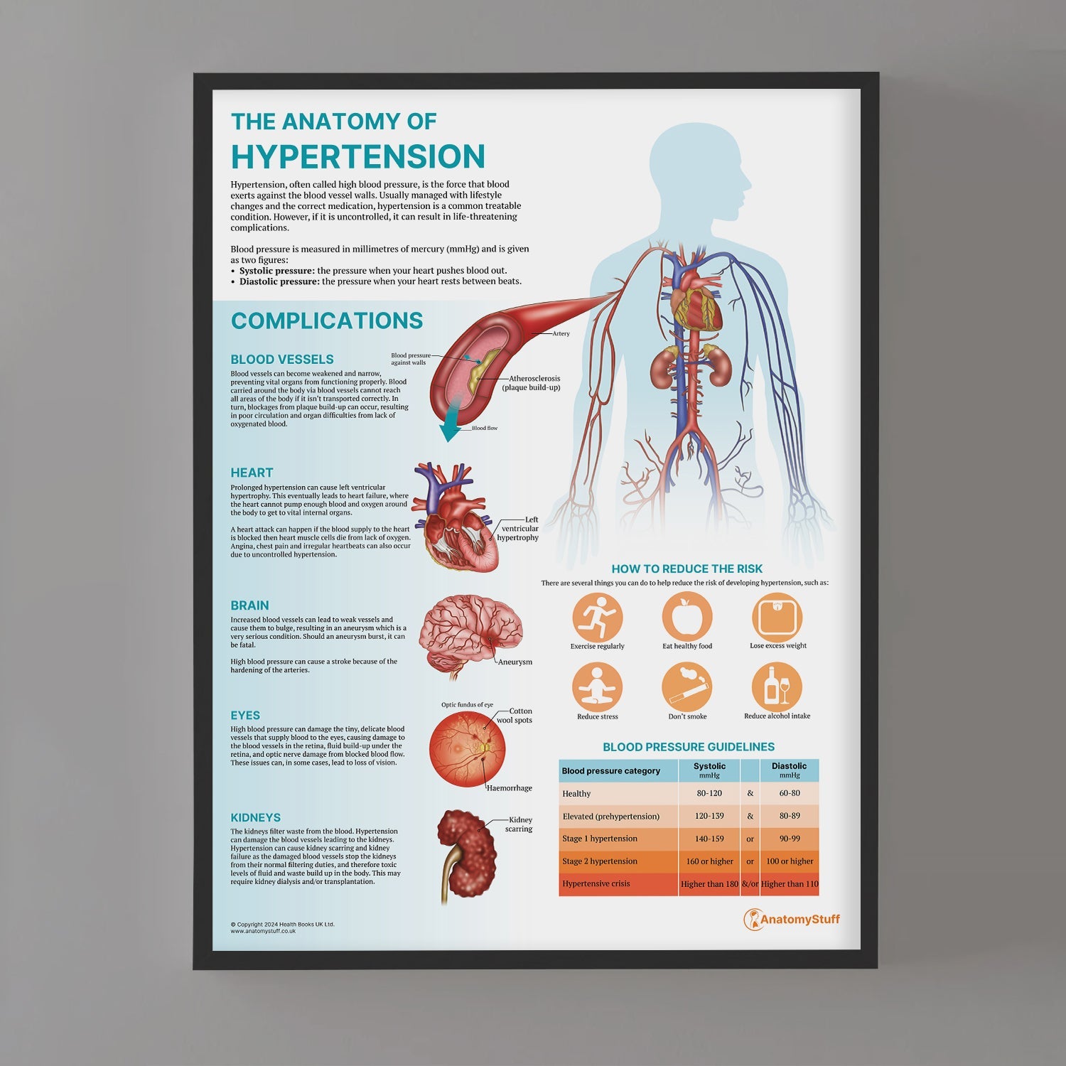 The Anatomy of Hypertension Chart / Poster - Part of Collection