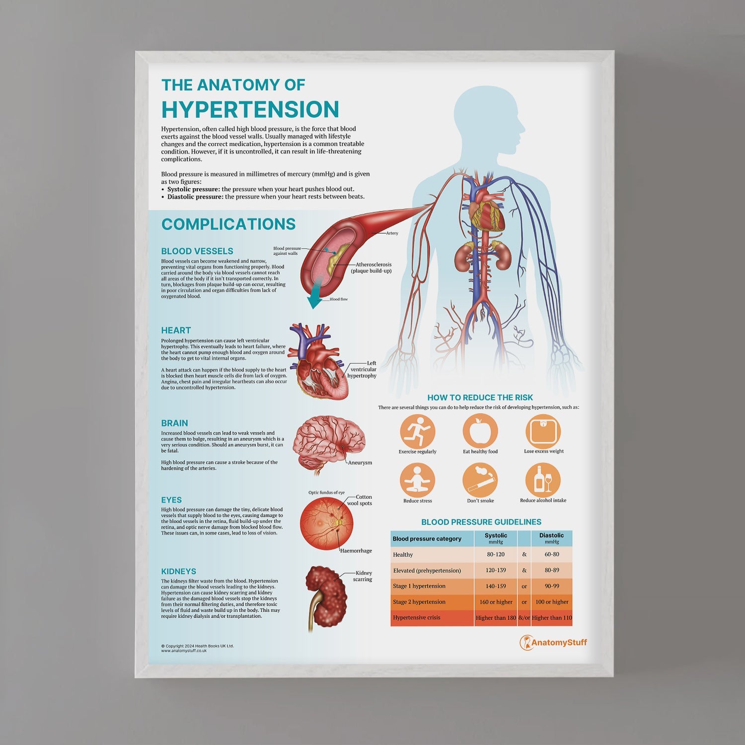 The Anatomy of Hypertension Chart / Poster - Part of Collection