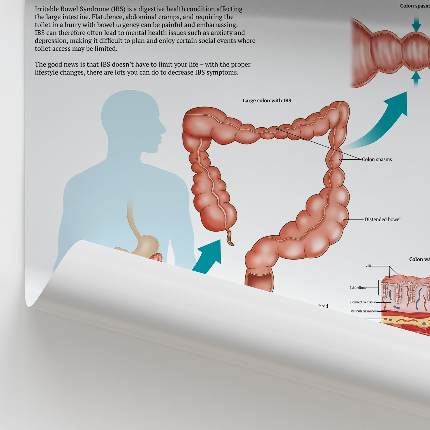The Anatomy of Irritable Bowel Syndrome (IBS) Chart / Poster - Part of Collection