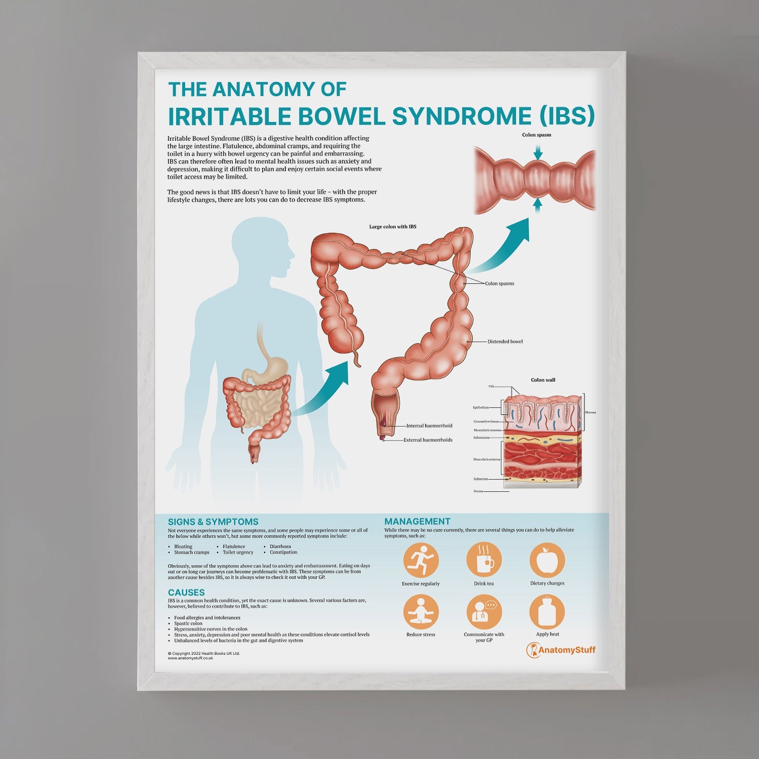 The Anatomy of Irritable Bowel Syndrome (IBS) Chart / Poster - Part of Collection