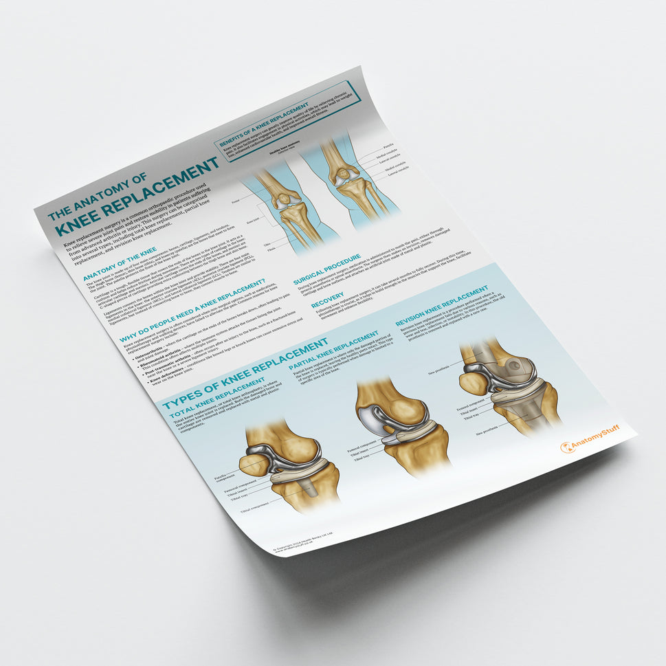 The Anatomy of Knee Replacement Chart / Poster