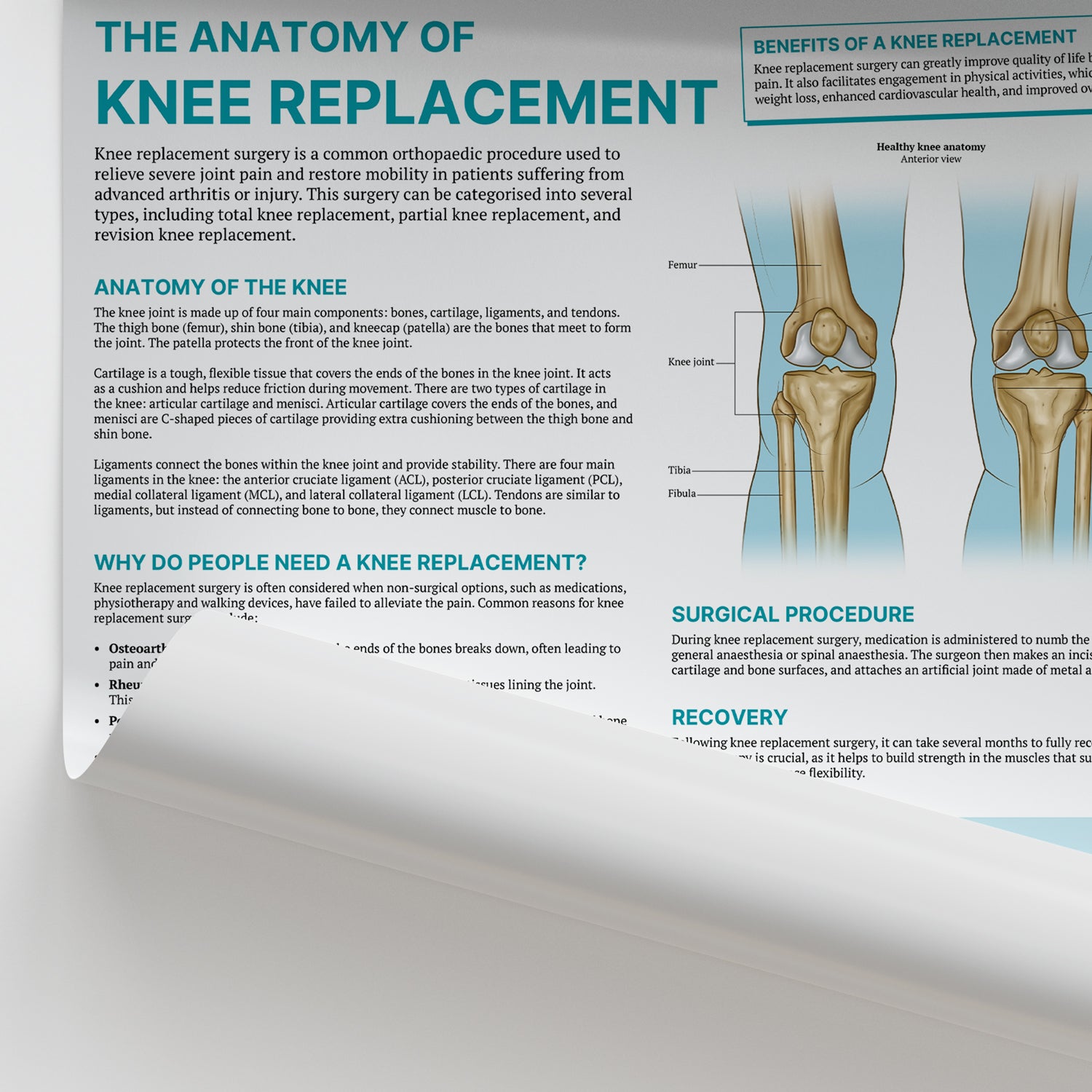 The Anatomy of Knee Replacement Chart / Poster