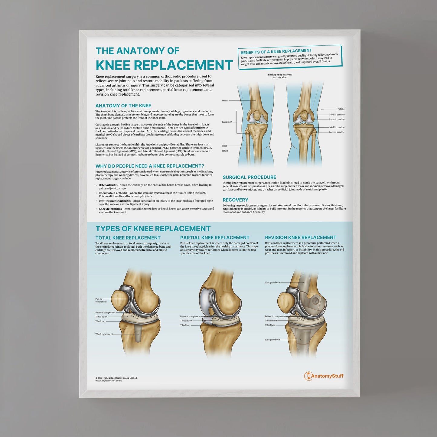 The Anatomy of Knee Replacement Chart / Poster