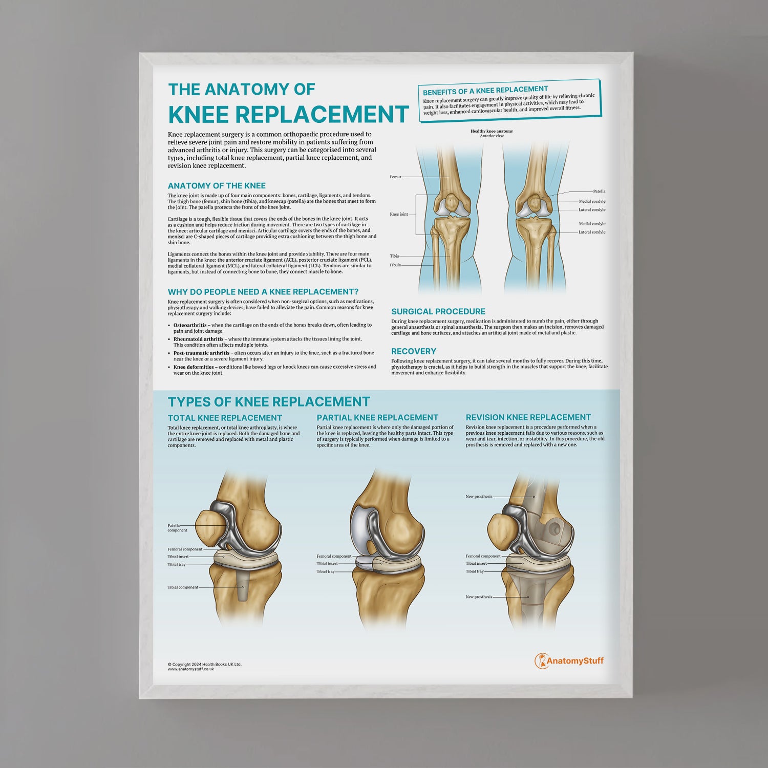 The Anatomy of Knee Replacement Chart / Poster