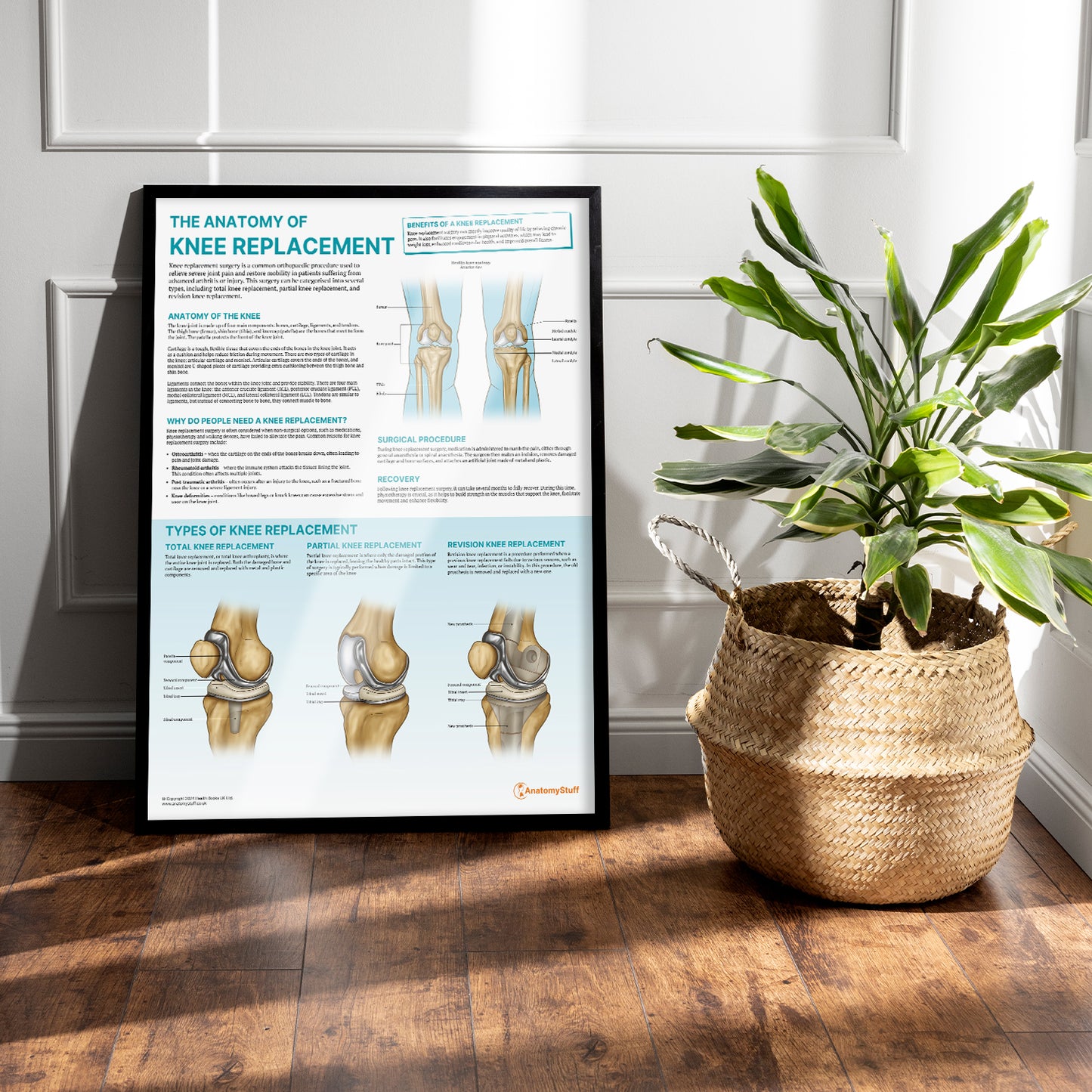 The Anatomy of Knee Replacement Chart / Poster