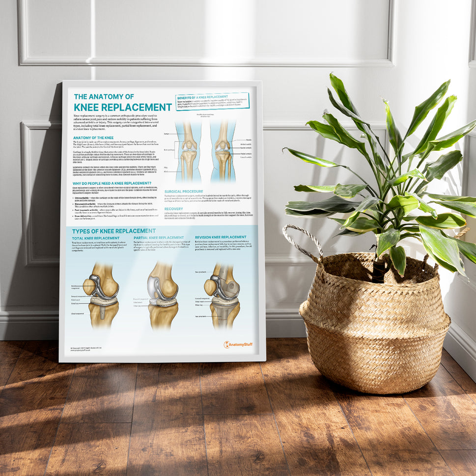 The Anatomy of Knee Replacement Chart / Poster