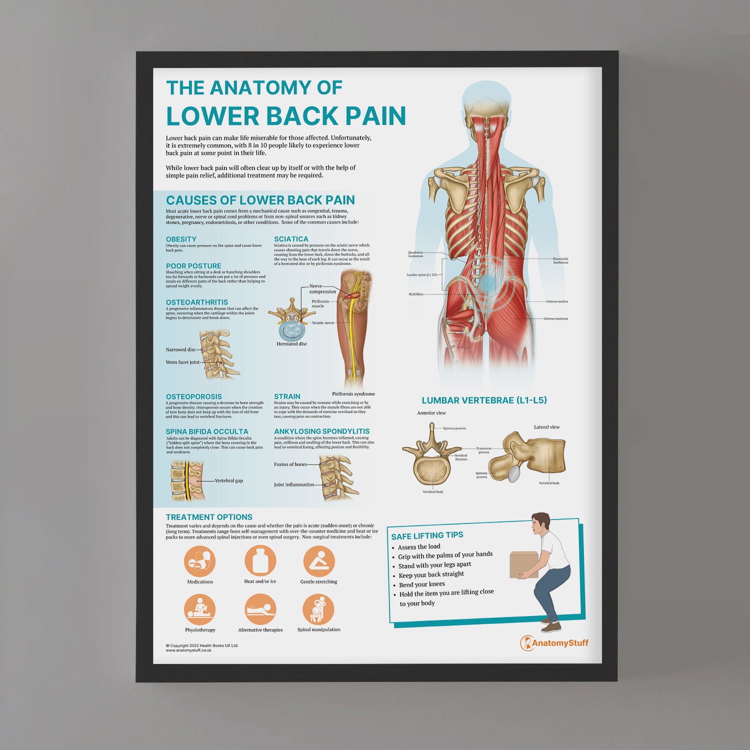 The Anatomy of Lower Back Pain Chart / Poster