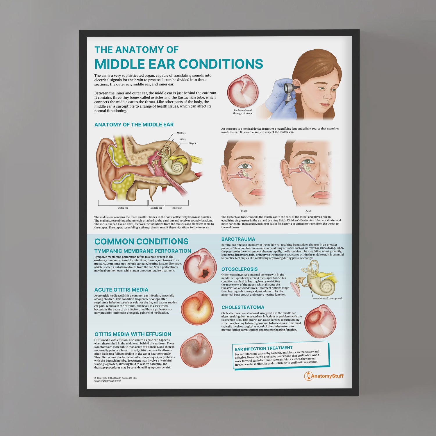 The Anatomy of Middle Ear Conditions Chart / Poster