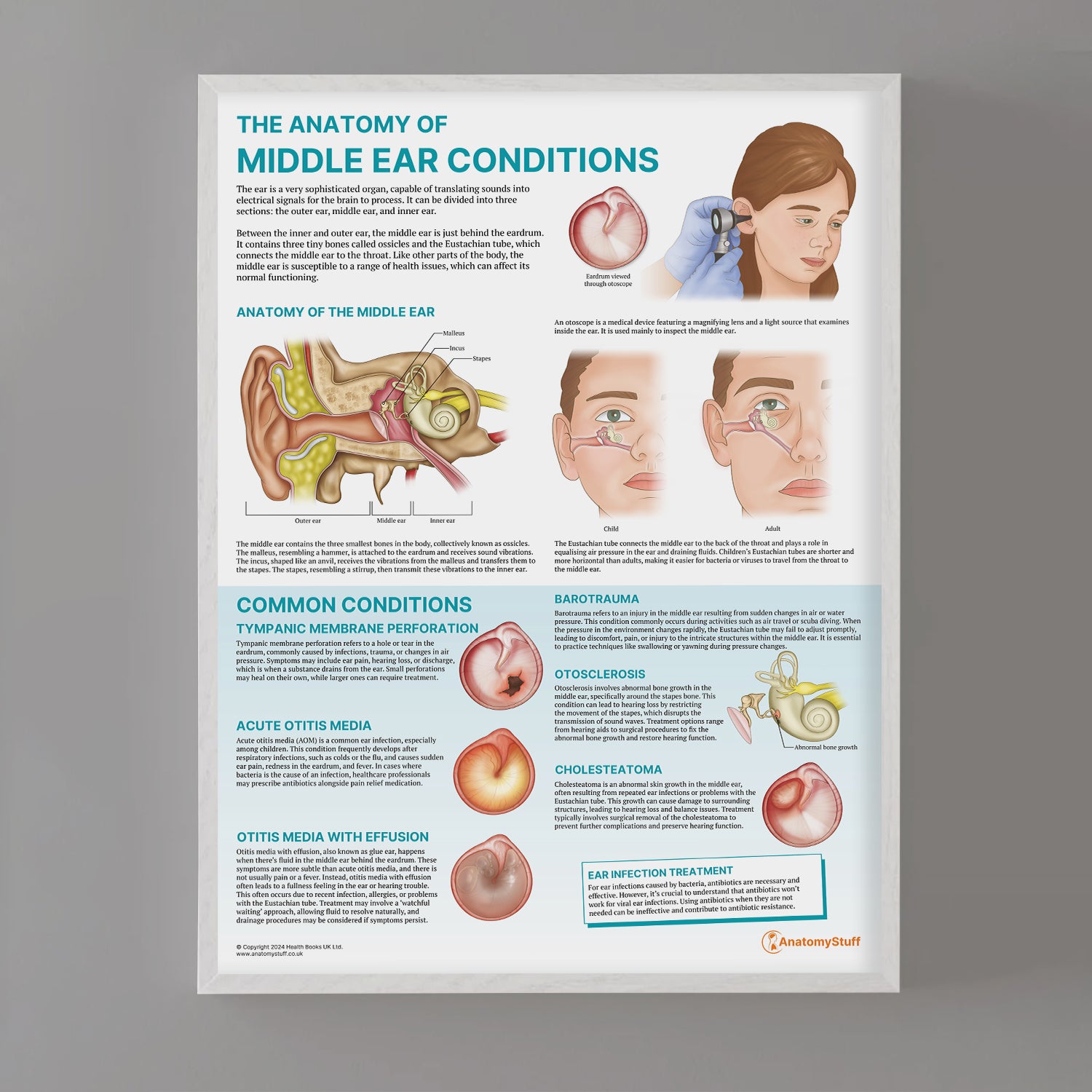 The Anatomy of Middle Ear Conditions Chart / Poster
