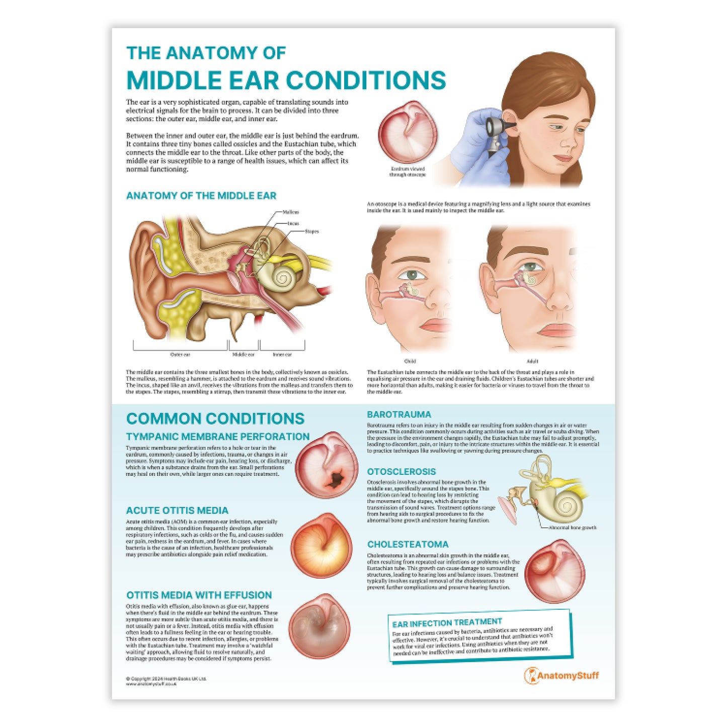 The Anatomy of Middle Ear Conditions Chart / Poster