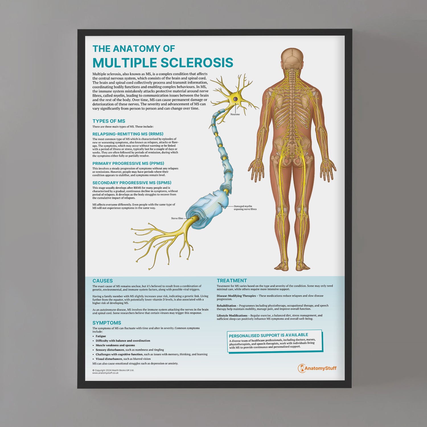 The Anatomy of Multiple Sclerosis Chart / Poster