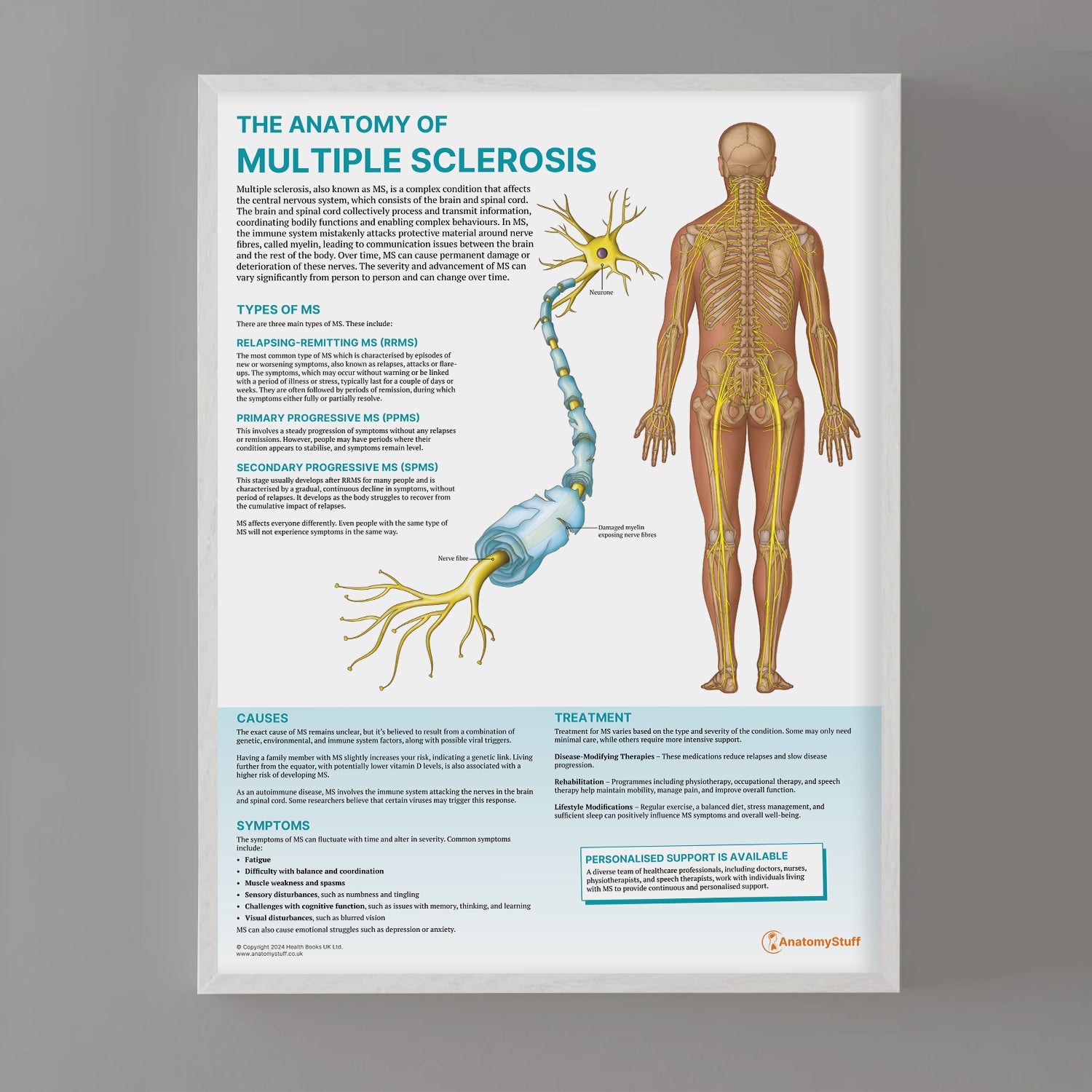 The Anatomy of Multiple Sclerosis Chart / Poster