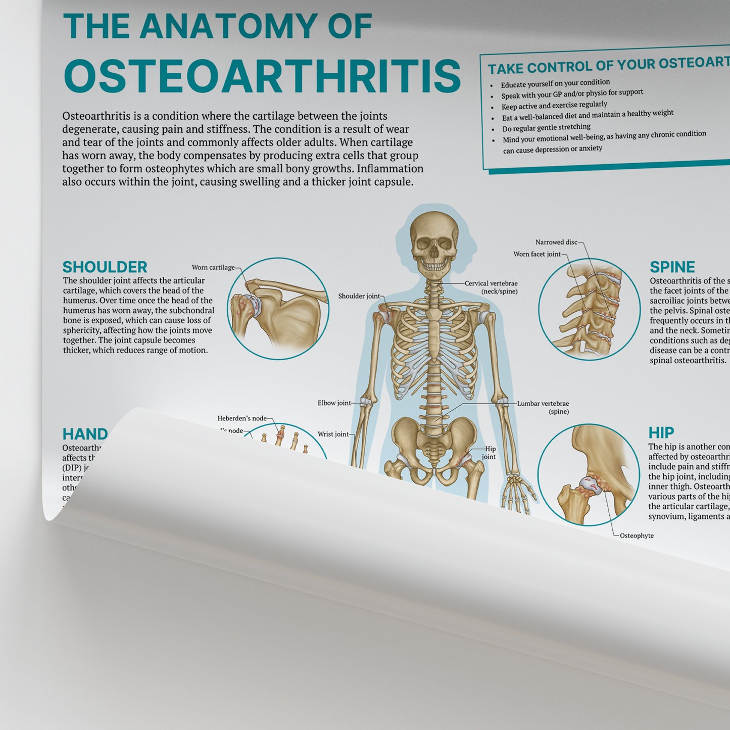The Anatomy of Osteoarthritis Chart / Poster
