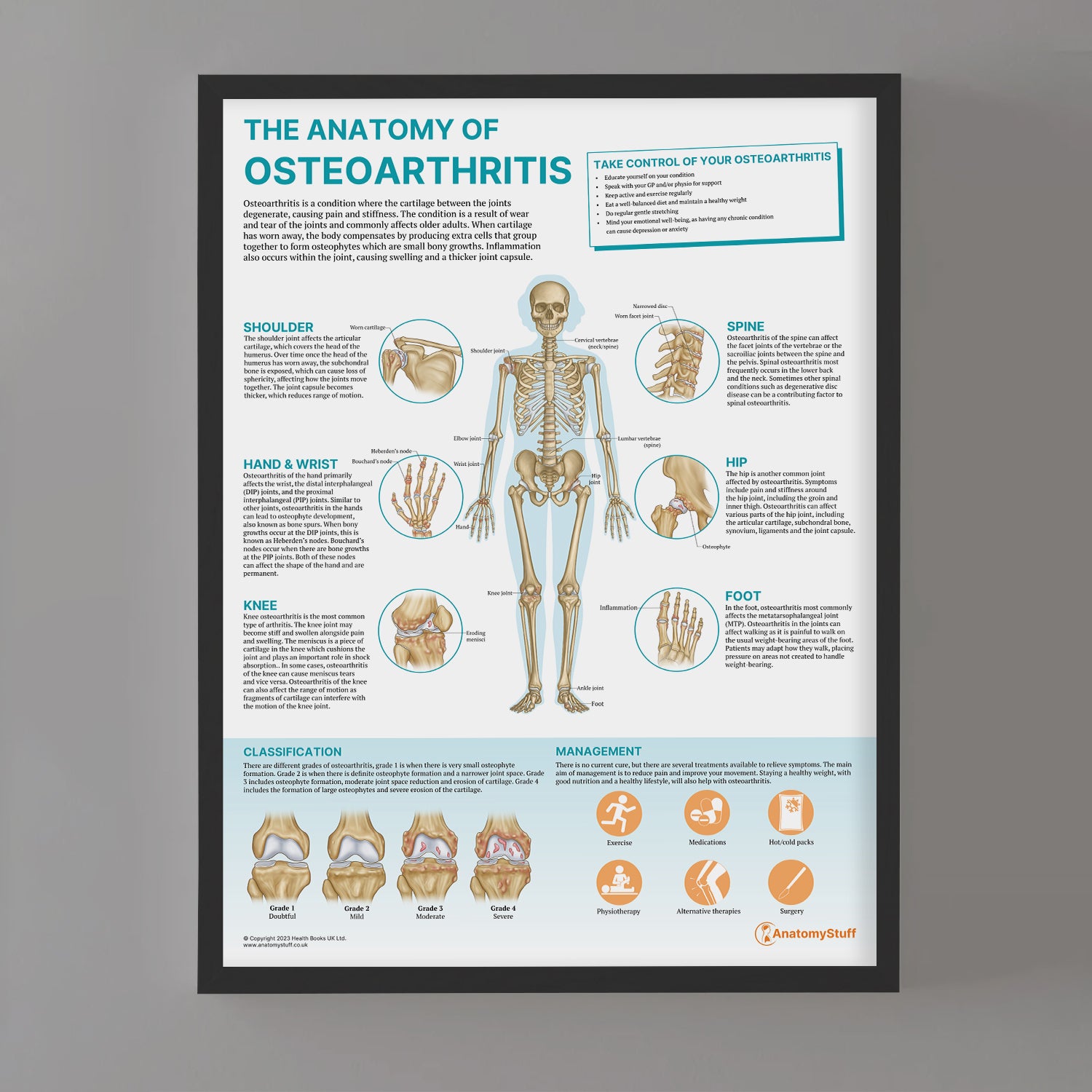 The Anatomy of Osteoarthritis Chart / Poster